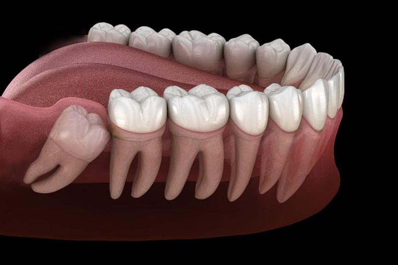 Dente del giudizio: cosa succede con una malposizione?