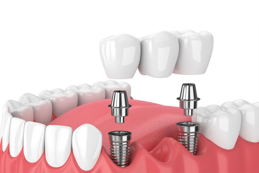 La protesi dentale fissa è meglio della dentiera