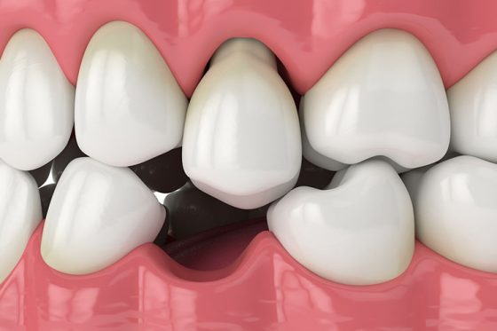 Cosa succede se non sotituiamo i denti mancanti