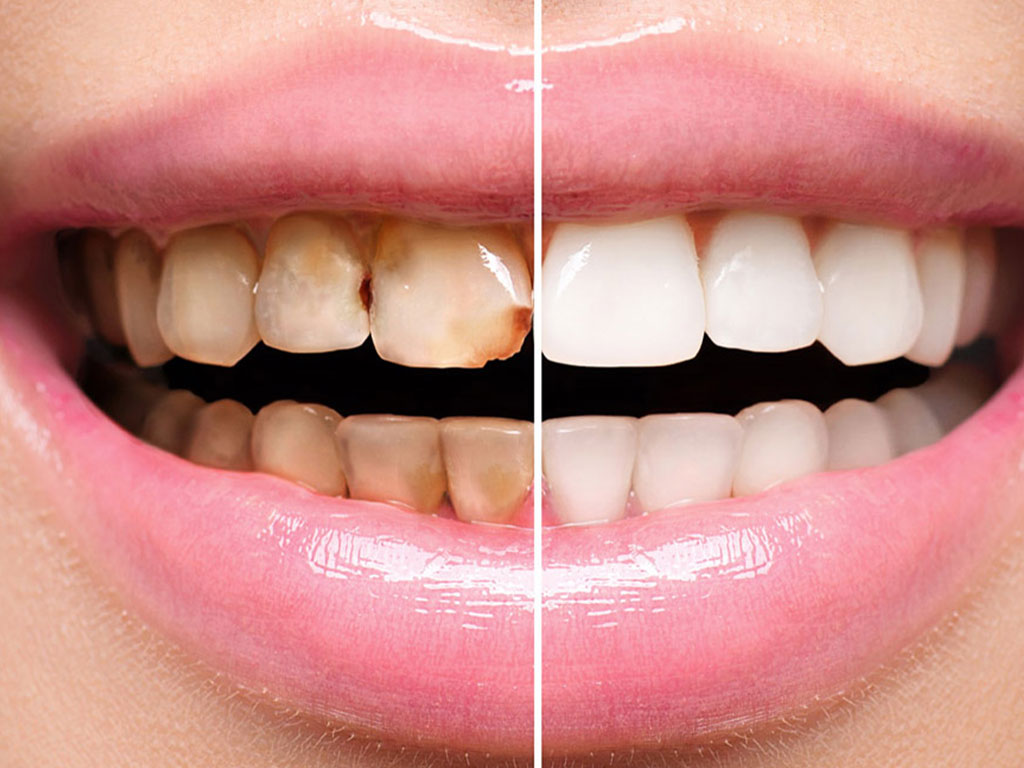 Faccette-dentali