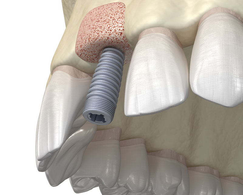 Perche sono necessari gli impianti dentali Studio dentistico Casani