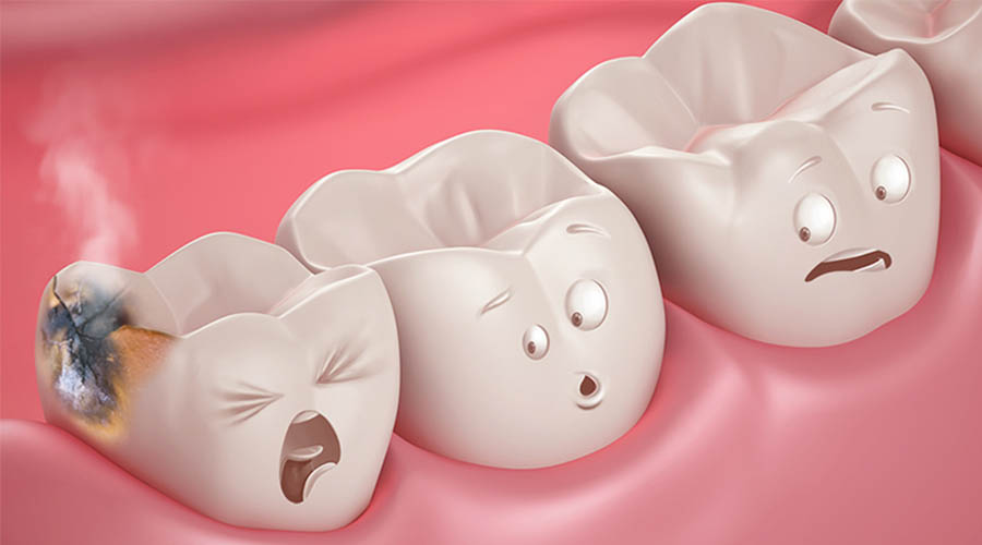 Come funzionano le otturazioni dal dentista?