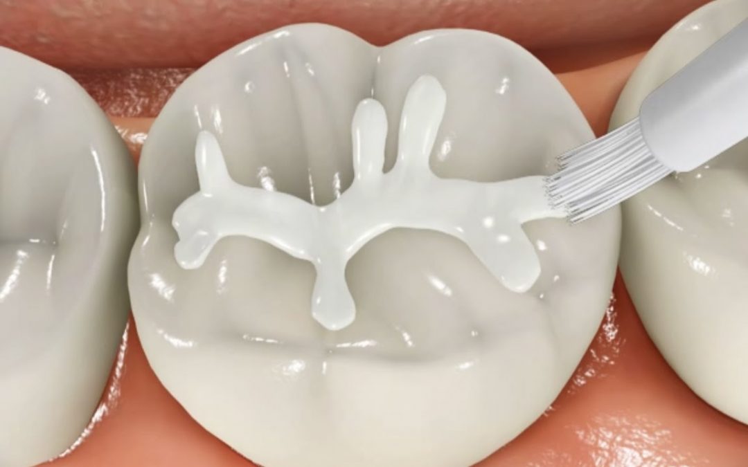 Sigillature dei denti nei bambini: perché sono importanti