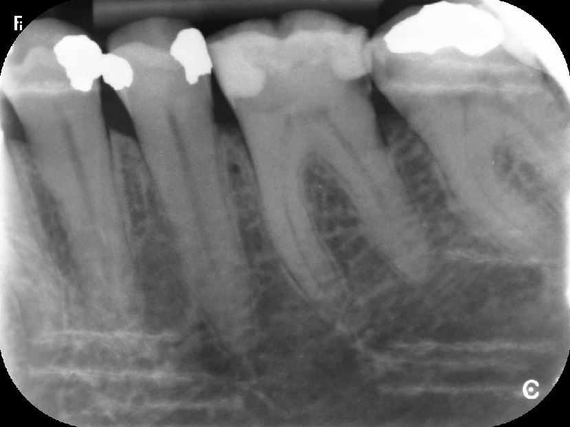 Radiografie bitewings: cosa sono e perché sono utili