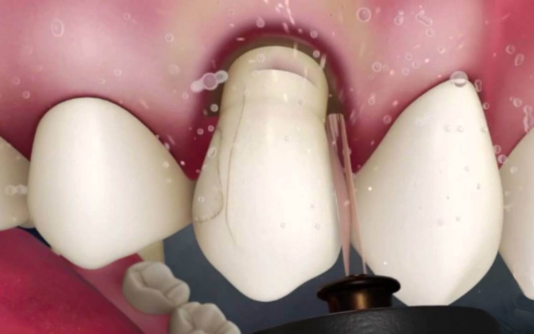 Allungamento della corona dentale: come avviene?
