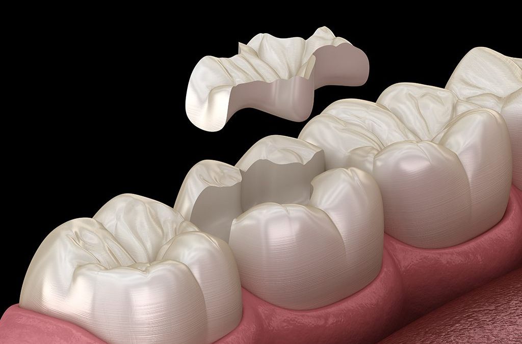 Che cosa è un intarsio dentale?
