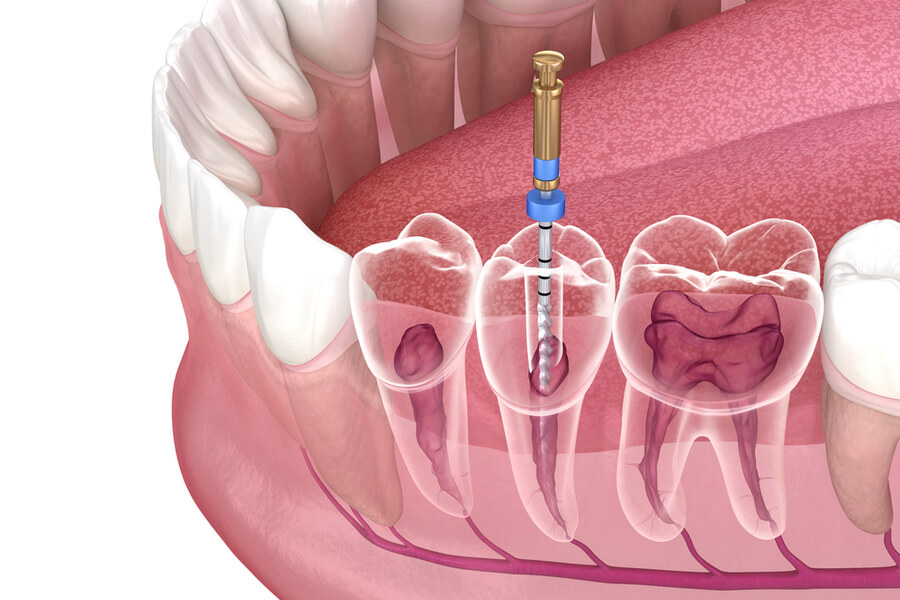 Cosa è l’endodonzia laser-assistita?