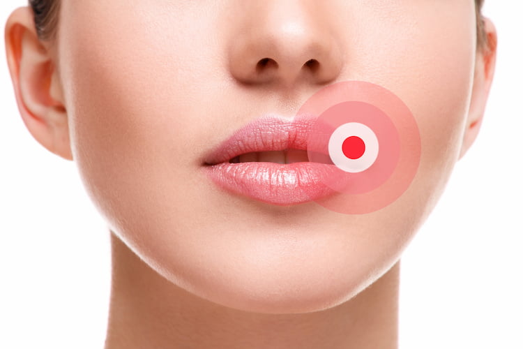 I benefici del laser nel trattamento di herpes e afte