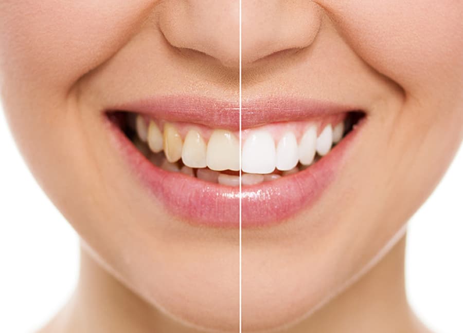 sbiancare i denti