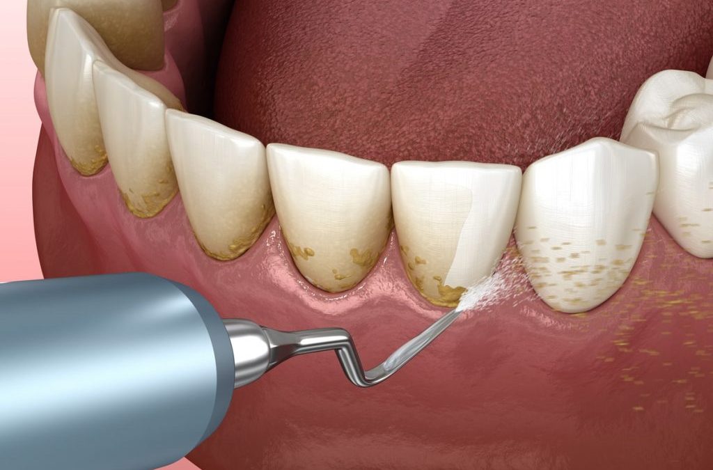 Quante malattie sono causate dalla placca batterica?