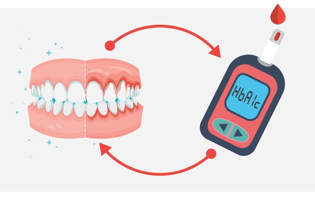 Quali correlazioni fra diabete, parodontite e impianti dentali?