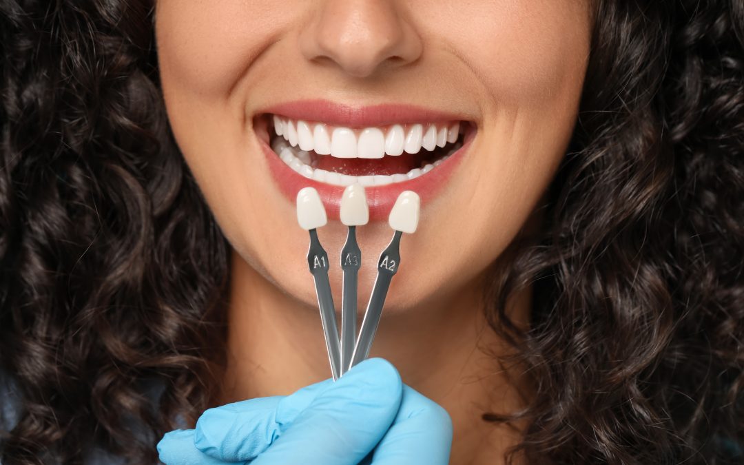 Guida completa ai materiali delle Faccette Dentali: quale scegliere?
