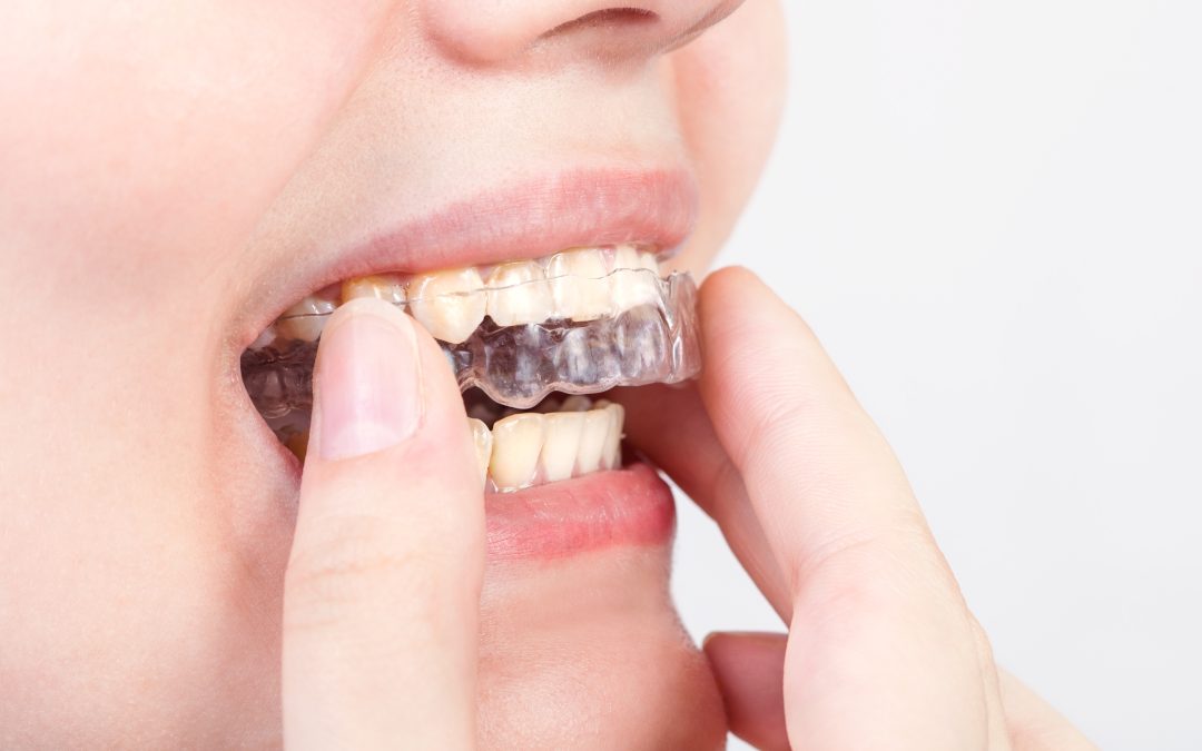 I tuoi denti si stanno consumando e non capisci perchè? Forse stai digrignando nel sonno